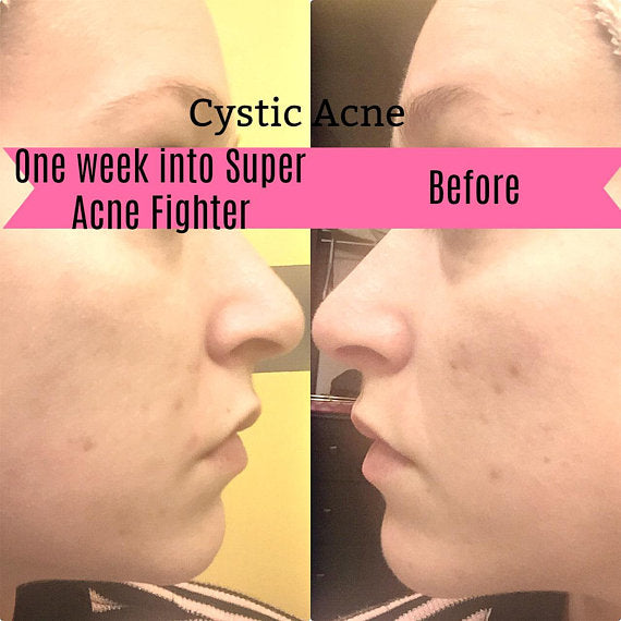 Super Acne Fighter / Tratamiento orgánico contra el acné / Acné